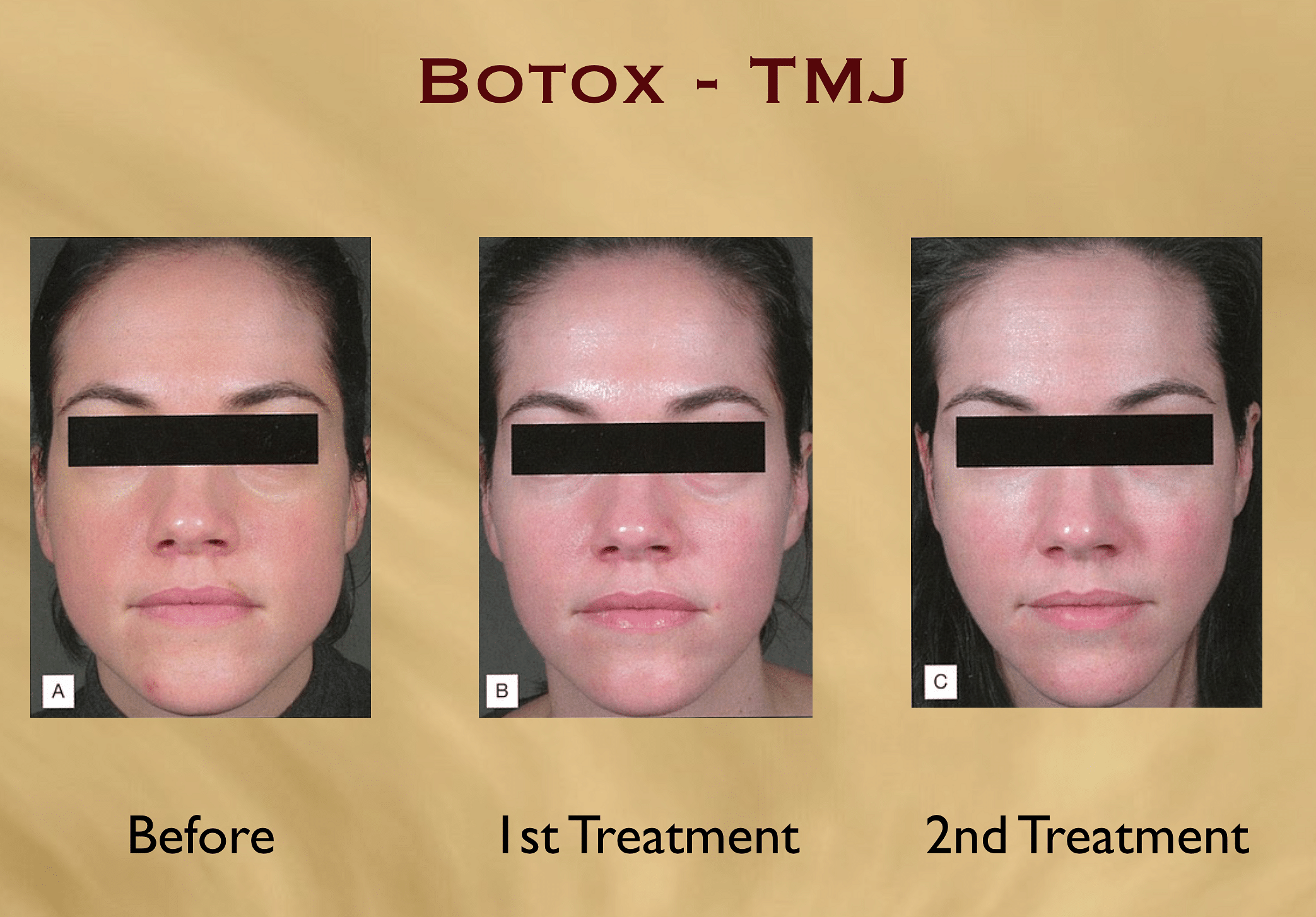 Botox injection into jaw muscle